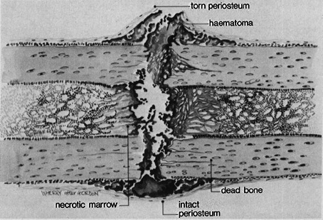 How Many Pounds Of Force Does It Take To Break Your Sternal Fracture