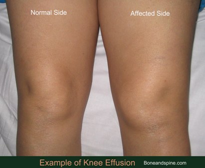What causes gout in the knee?