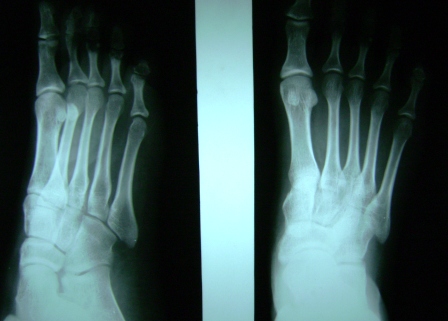 This is how an xray of a normal foot looks like. The present image shows an 