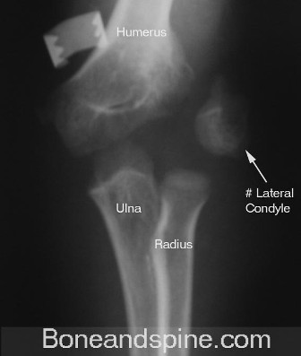 osteoporosis x ray. The Xray in picture shows