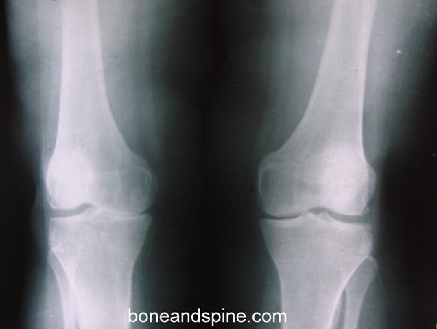 Osteoarthritis of knee is very common problem in Asian region.