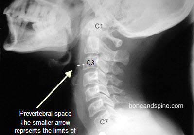 Prevertebral Space and Its Importance? | Bone and Spine