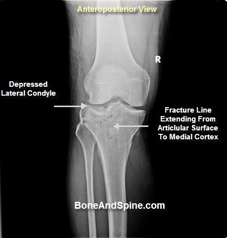 Xray Pictures of Fractured Tibia | Bone and Spine