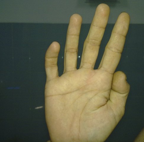 Claw Hand Deformity