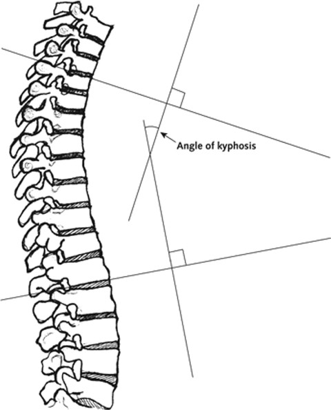 angular kyphosis