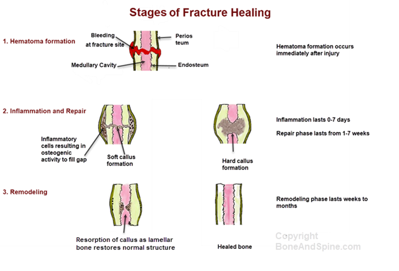 stages of fracture healing