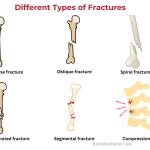 Different Types of fractures based on fracture configuration