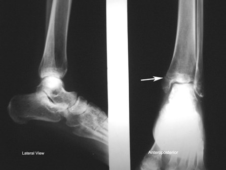 Xray Ankle showing fracture of medial malleolus