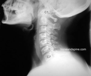 normal x-ray of cervical spine