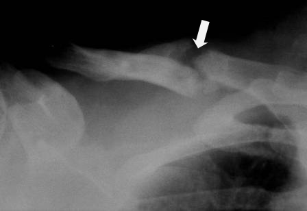 Clavicle Fracture