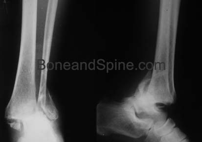 Xrays of Bimalleolar Fracture With Ankle Dislocation