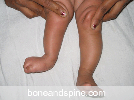 Common causes and conditions of Leg Length Discrepancy (LLD)