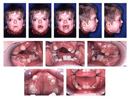 Apert Syndrome