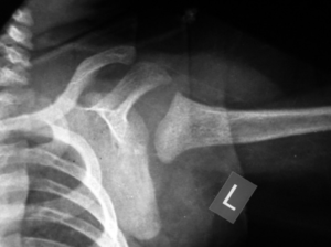 congenital dislocation of shoulder