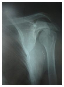 glenoid hypoplasia is an important of congenital anomalies of shoulder