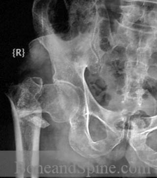 Intertrochanteric Femur Fracture unstable type