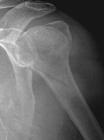 Fracture of Humerus