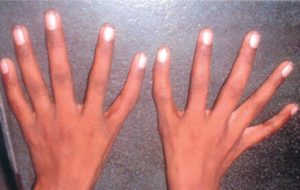 triphalangeal thumb photo