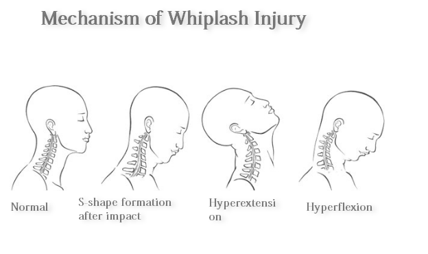 hyperextension neck