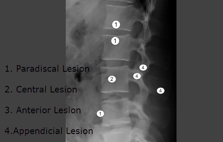 Types of lesion in tuberculosis of spine