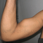 Ruptured Distal Biceps Tendon