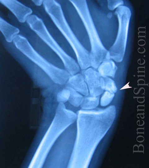 Fracture of scaphoid