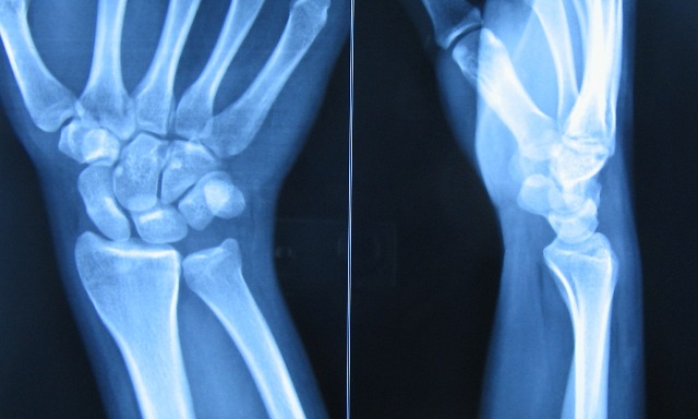 PA and lateral views of wrist