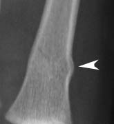 buckle fracture example, also called torus fracture