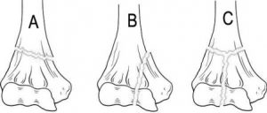 classification-distal-end-of-humerus-fractures