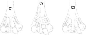 classification-distal-humerus-fractures