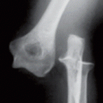 Lateral Dislocation of Elbow