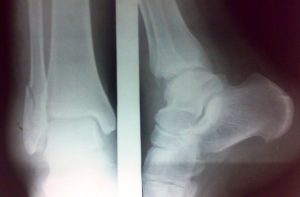 Fracture of Lateral Malleolus. Anteroposterior and lateral views.