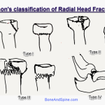 mason classification of radial head fractures
