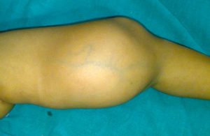 Lipoma of Thigh in 7 Yeras old