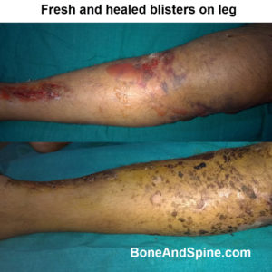 Fresh and Healed Blisters on Leg