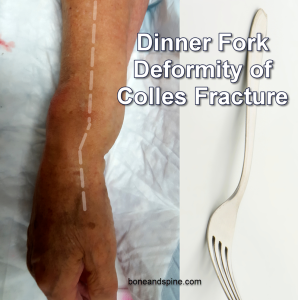 Colles fracture dinner fork deformy