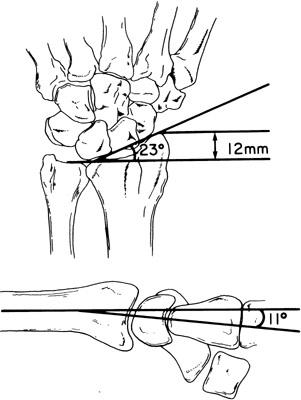 distal radial lenght, ulnar variance and other values