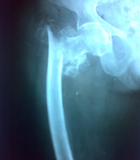 Unstable ntertrochanteric Fracture of Femur