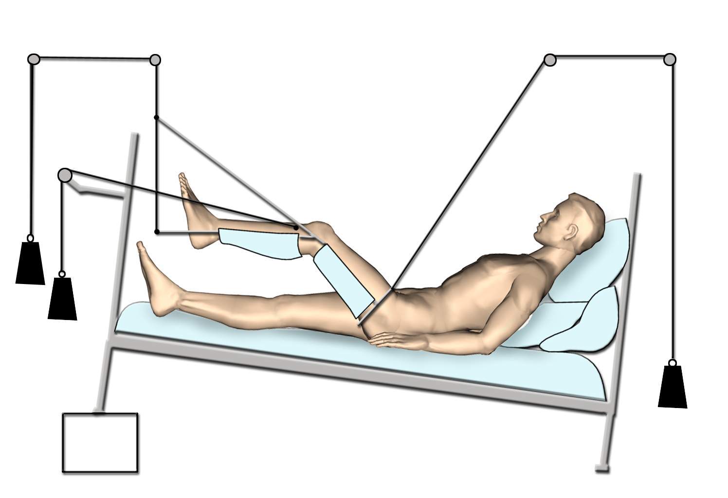 Skeletal Traction - Indication, Uses and Complications