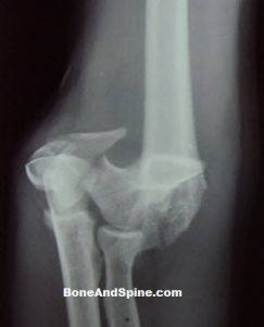 intercondylar-fracture-humerus-ap-view