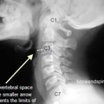 prevertebral space in cervical spine