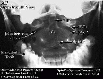 Open mouth view xray