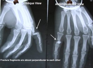 Fracture-proximal-phalanx-little-finger