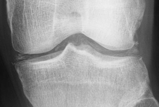 pseudogout - chondrocalcinosis