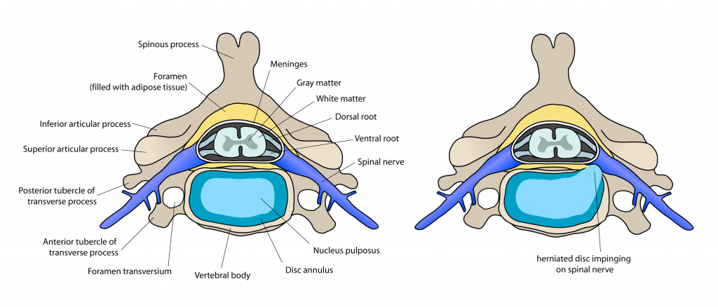 Spinal disc herniation