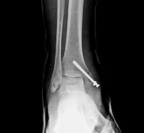 Xrayof Fracture of Medial Malleolus Fixed With Malleolar Screw