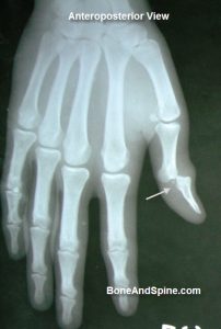 interphalangeal-joint-dislocation-thumb