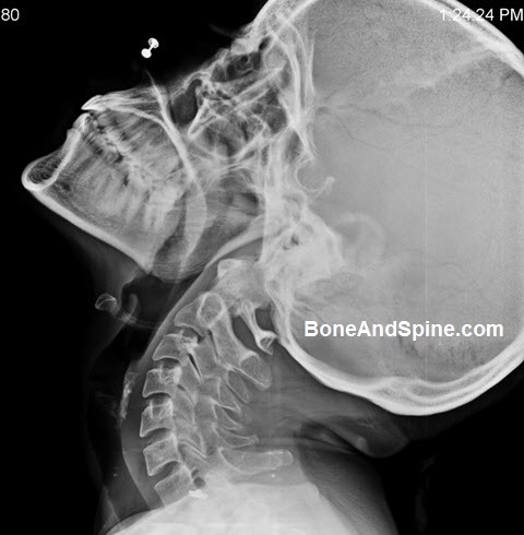 Xray cervical spine AP and lateral shows straightening of cervical