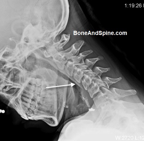 his cervical spine - Traducere în română - exemple în engleză | Reverso Context