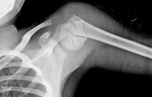 shoulder injuries - fracture upper end humerus